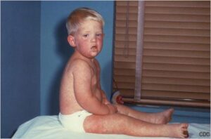 Child with a measles rash sitting on an exam table